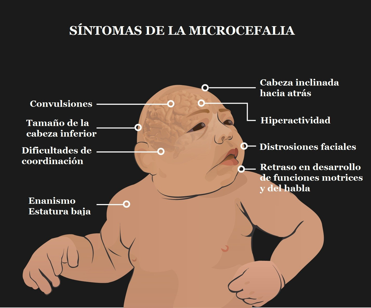 Microcefaliasintomas