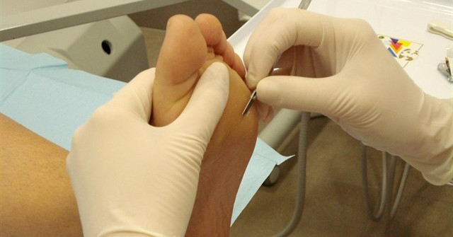 El CHUS implanta una unidad de pie diabético para reducir a la mitad las amputaciones