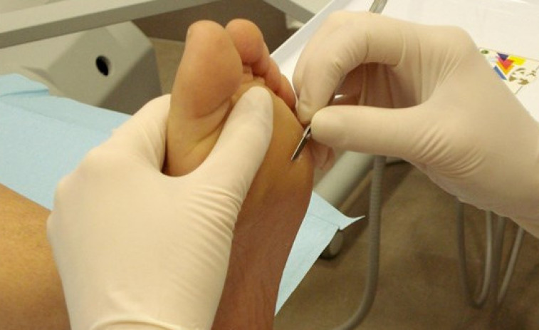El CHUS implanta una unidad de pie diabético para reducir a la mitad las amputaciones