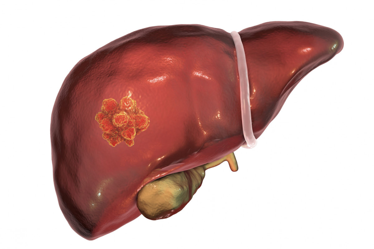 Liver cancer