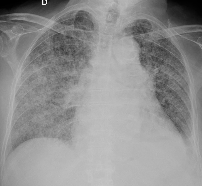653px Chest radiograph of miliary tuberculosis 2