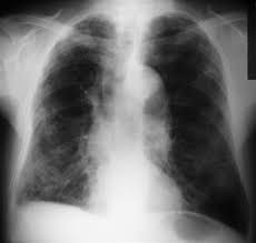 Pulmones en una imagen de archivo