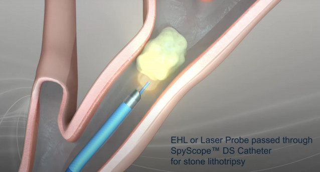 La técnica permite extraer cálculos biliares con un acceso mediante el hígado