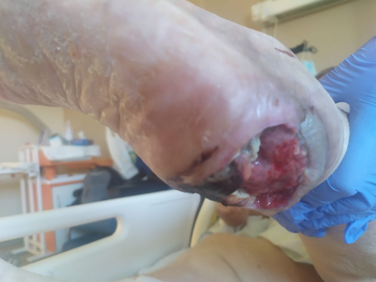 Imagen de una u00falcera en el pie de la anciana difundida por su familia