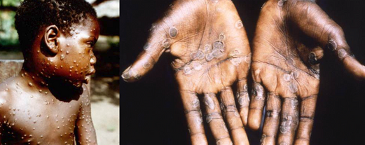 Imagen de un paciente de viruela del mono publicada por la OMS