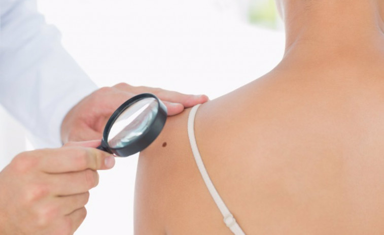 Quirónsalud nos enseña la “regla ABCDE” para prevenir e identificar los melanomas este verano