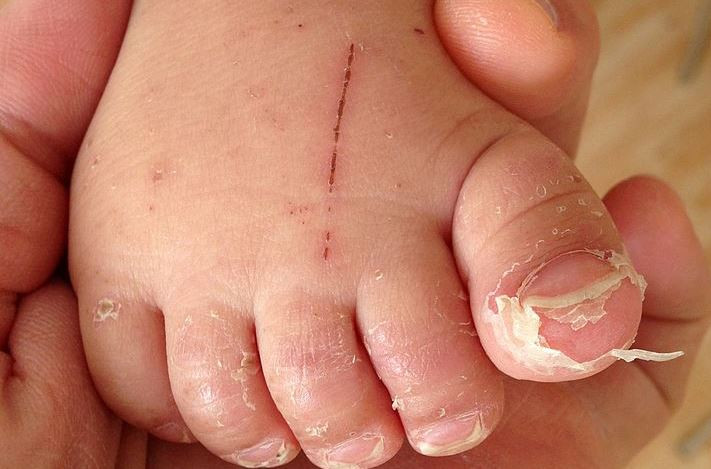 Descamaciu00f3n tu00edpica de los dedos de los pies despuu00e9s de una enfermedad por enterovirus u otras enfermedades como la escarlatina en una foto de Gzzz Creative Commons Attribution Share Alike 4 0