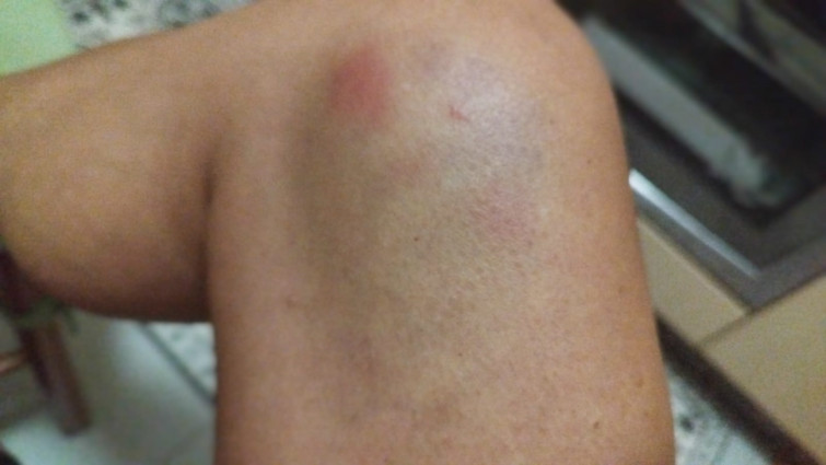 Así quedó la pierna de la vigilante de seguridad atropellada en el Hospital Álvaro Cunqueiro de Vigo