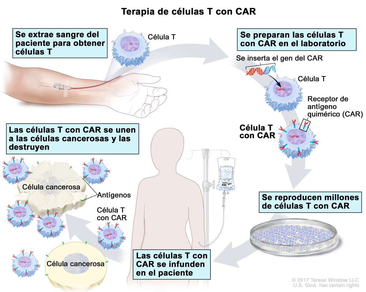 Terapia de cu00e9lulas CAR T en un gru00e1fico del Instituto Nacional del Cu00e1ncer de Estados Unidos