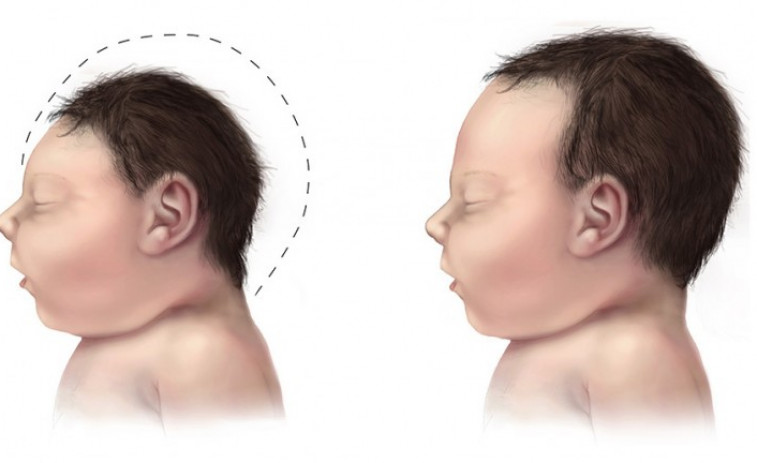 Nace en Cataluña el primer bebé de Europa con microcefalia por el virus del zika