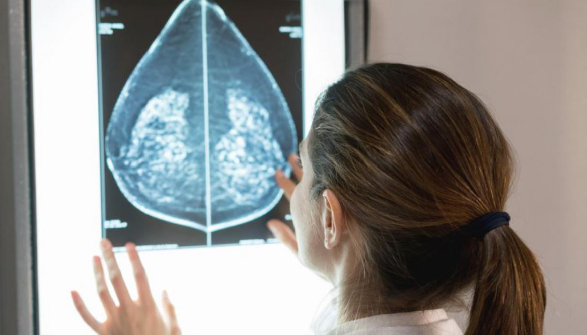 Cribado de cáncer de mama con una imagen obtenida en un mamógrafo