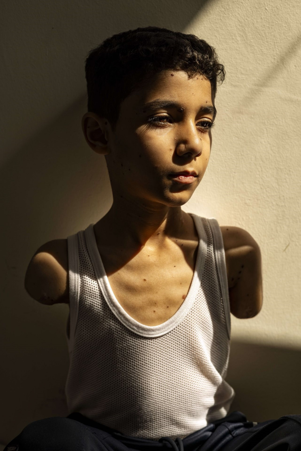 Mahmoud, un niño de Gaza mutilado, foto del año del World Press Photo.