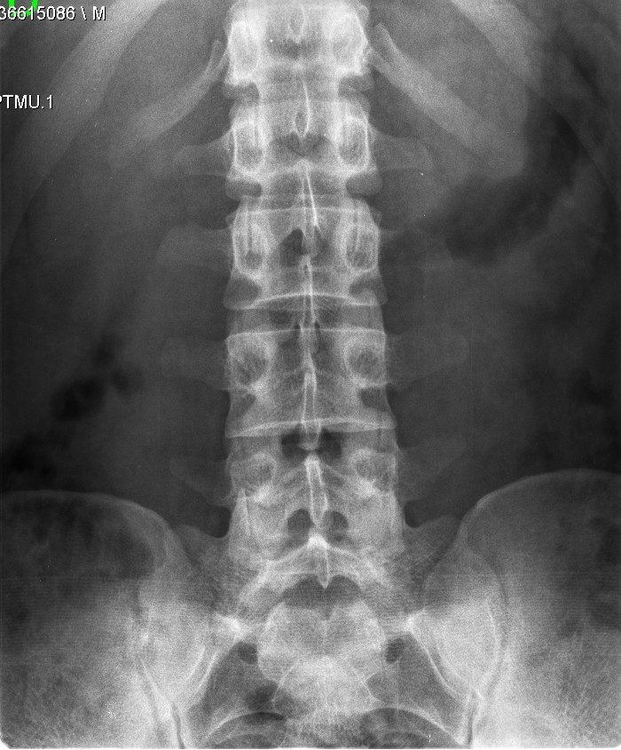 El SERGAS no vio daño en las vértebras de un niño de Vigo que quedó parapléjico tras una caída