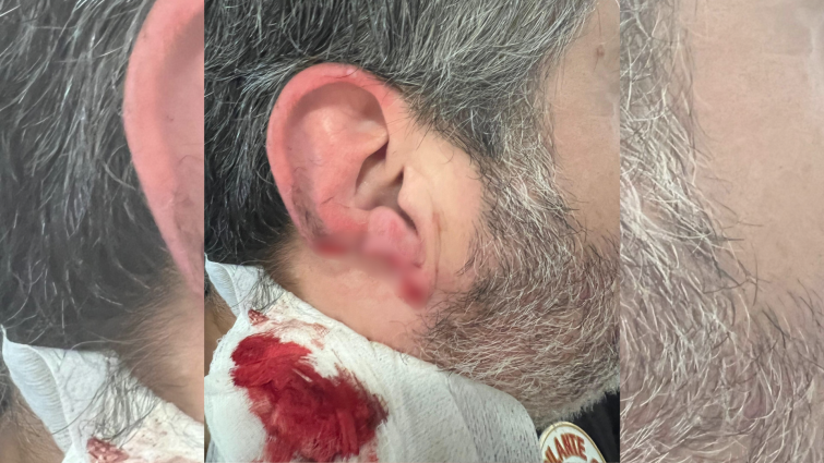 Prosegur, denunciada tras perder un vigilante de seguridad parte de la oreja en una agresión en el Hospital de Oza