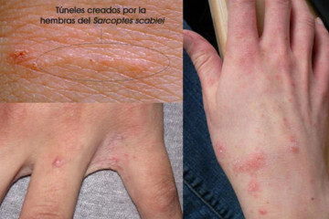 Lesiones de sarna