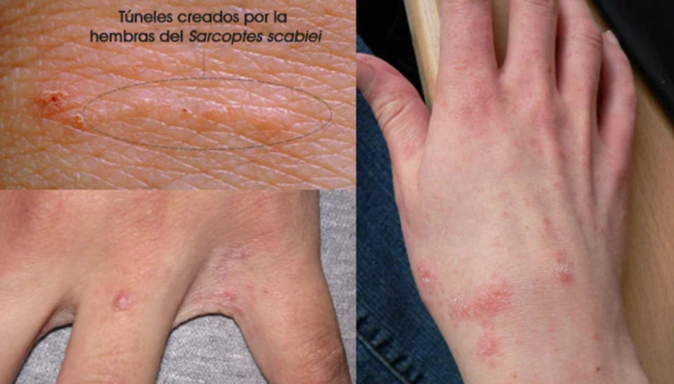 Lesiones de sarna