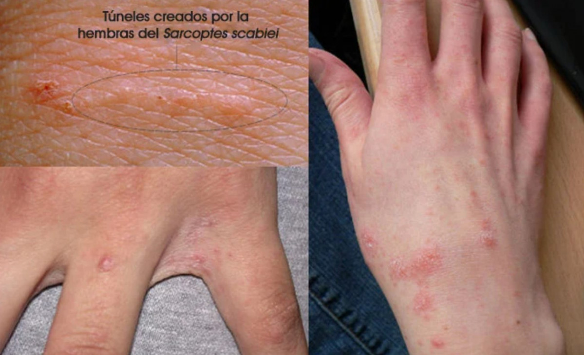 Lesiones de sarna