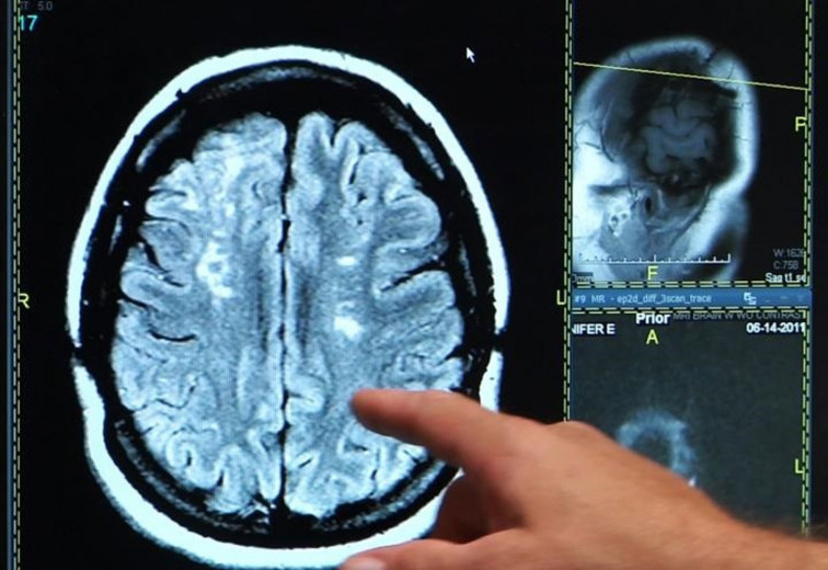 La incapacidad para reconocer nuestra propia enfermedad, el daño cerebral y su dolor silencioso