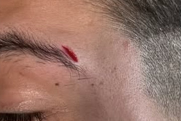 Corte en la ceja tras la agresión en una imagen publicada en Instagram por daviddeyone