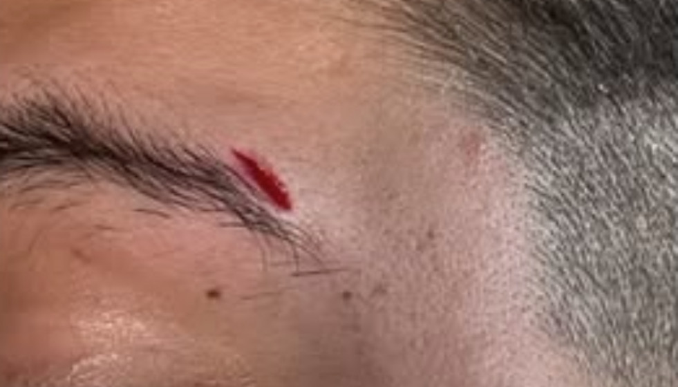 Corte en la ceja tras la agresión en una imagen publicada en Instagram por daviddeyone