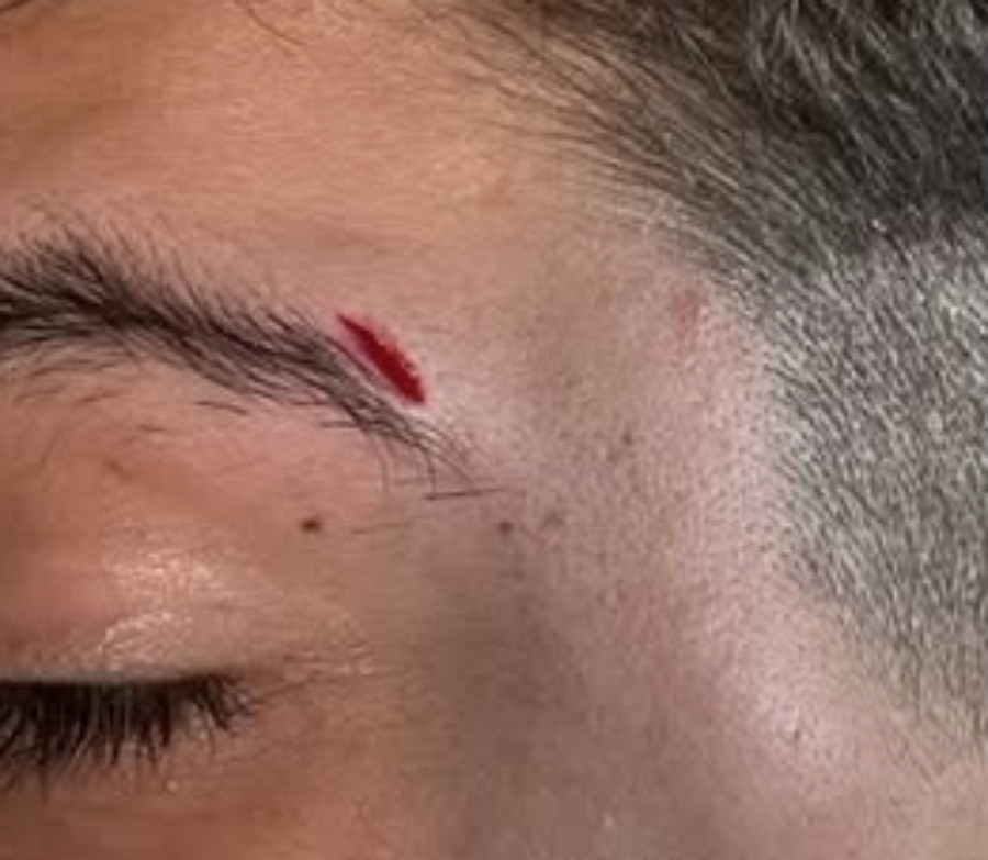 Corte en la ceja tras la agresiu00f3n en una imagen publicada en Instagram por daviddeyone